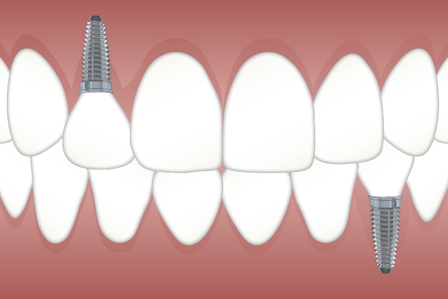 L’implant dentaire basale
