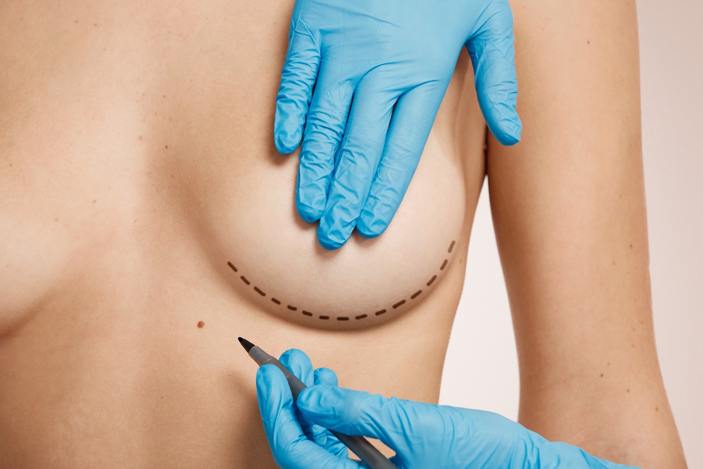 Lipofilling mammaire : Avantages, inconvénients et alternatives pour une poitrine naturelle
